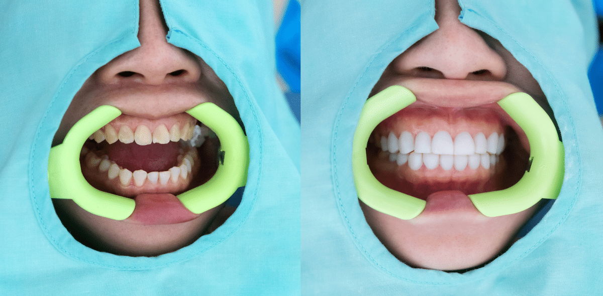 The Pros and Cons of Getting Veneers: Is it Worth It?