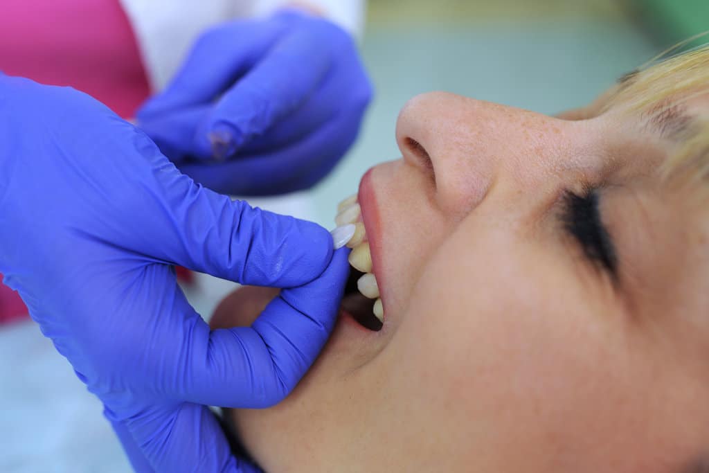 Things to Know Before Getting Dental Veneers