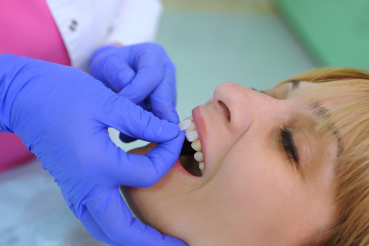 Porcelain Veneers vs. Composite Veneers: Which Option Is Right for You?