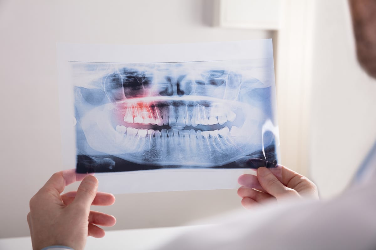 When Do You Need to Have Your Wisdom Teeth Removed?
