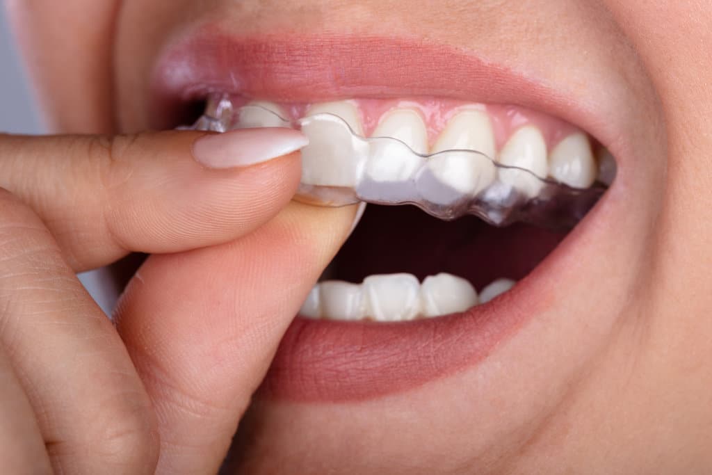 What Are the Benefits of Clear Aligners?
