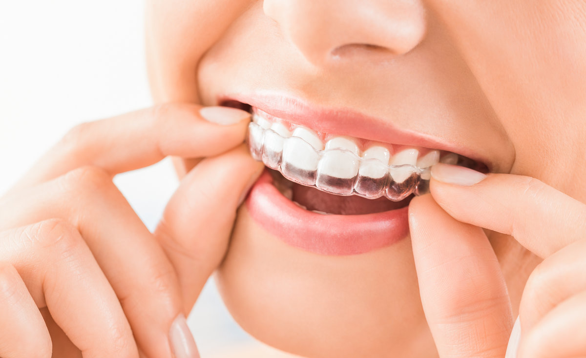 How Long Does Invisalign Take?  