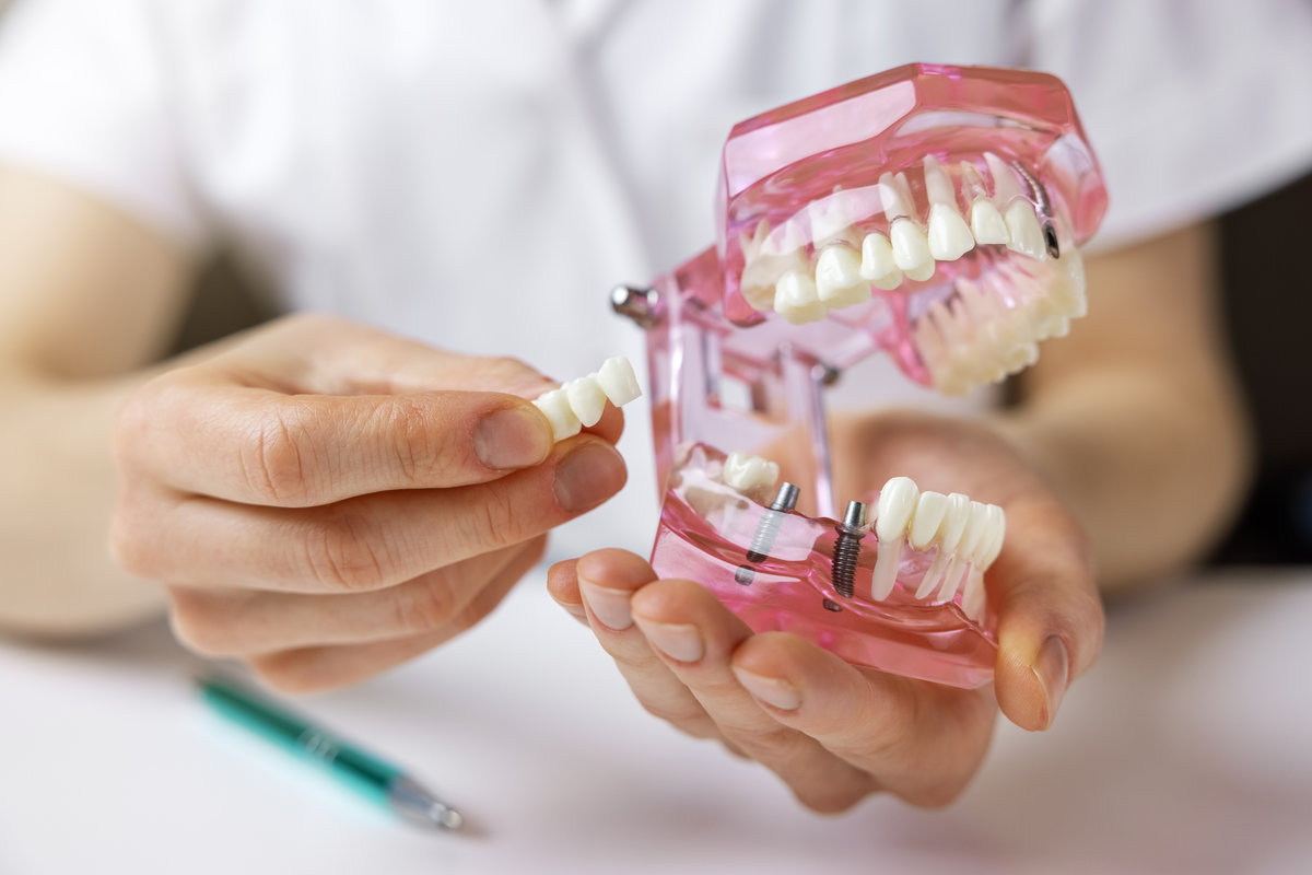 Tooth Replacement Options for Missing Teeth 