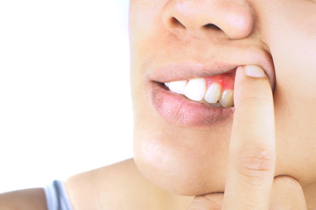 What Are the Warning Signs of Gum Disease and How Can It Be Reversed?